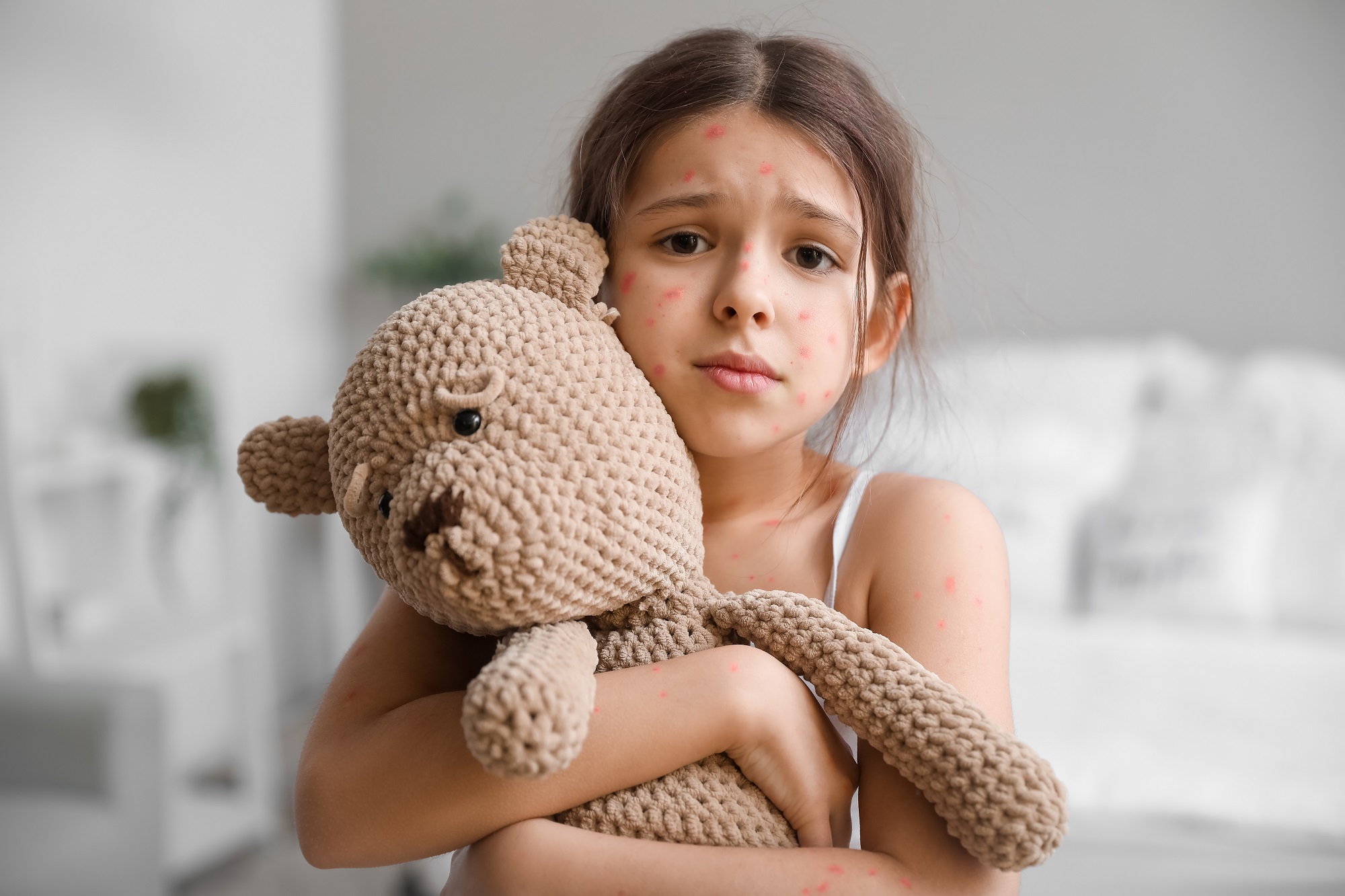 Вітряна віспа (вітрянка): важливі поради лікаря