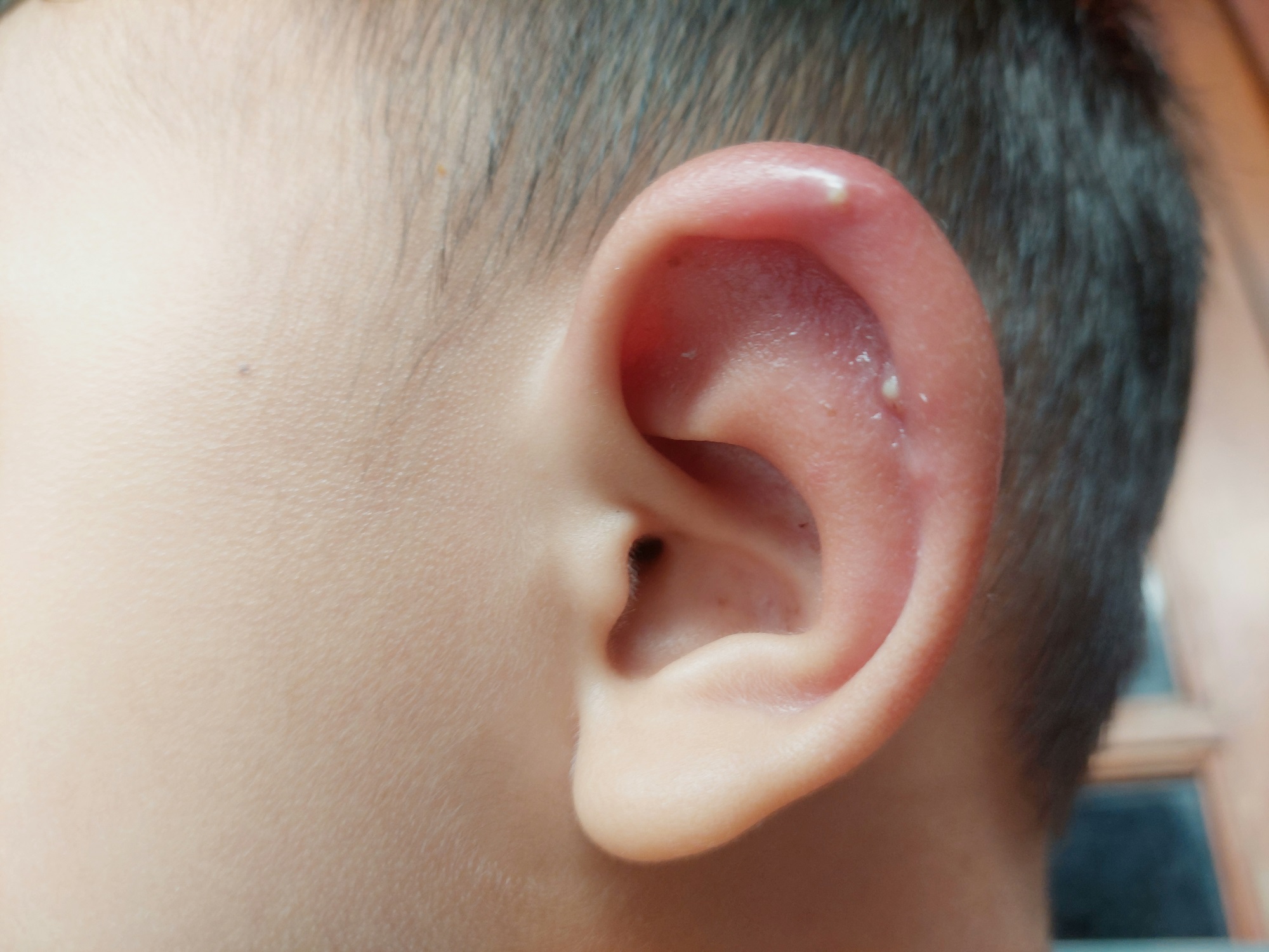 Чи можна лікувати фурункули самостійно?