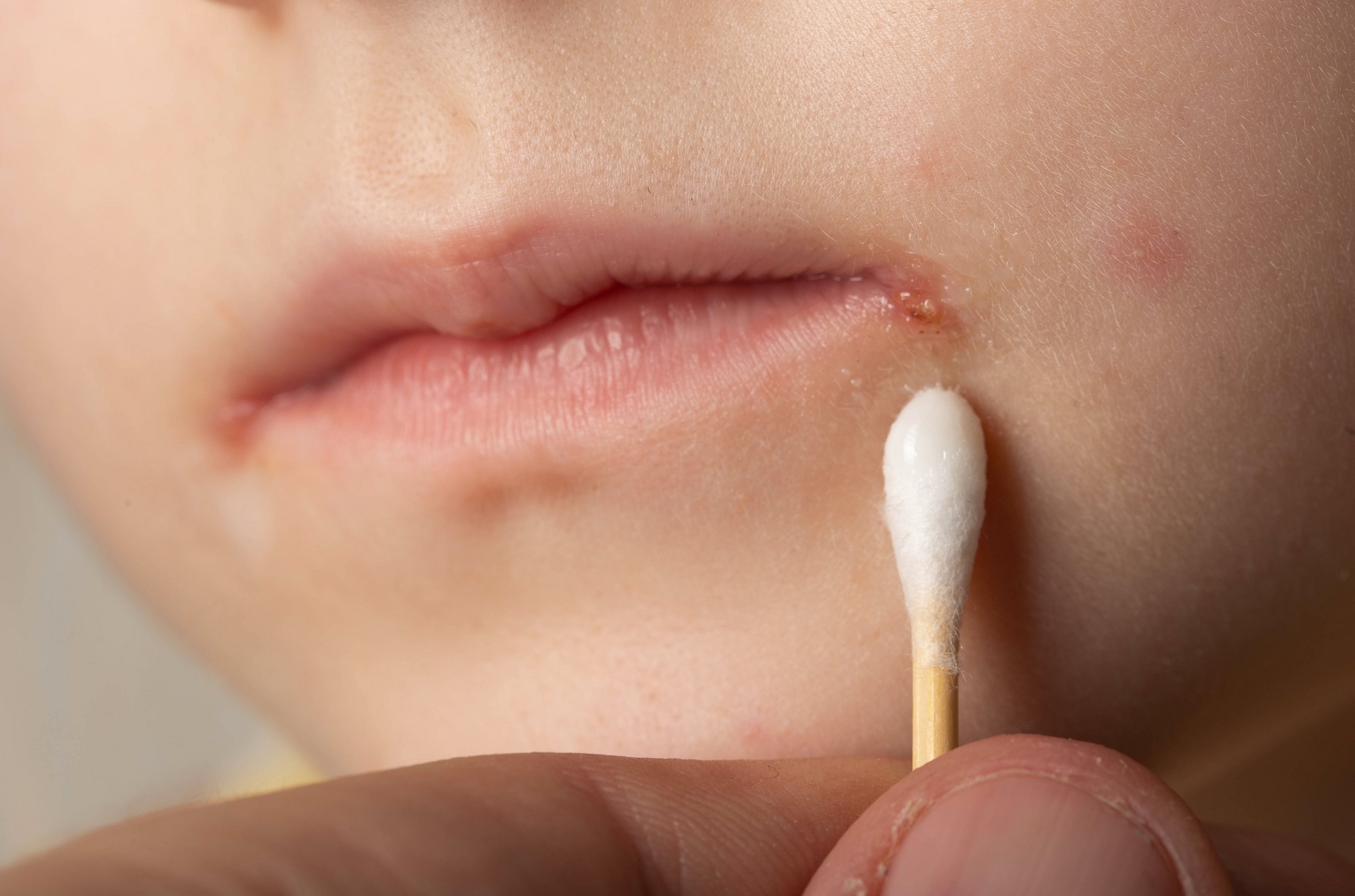 Піодермія у дітей